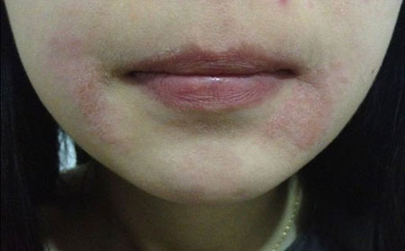 女性银屑病患者应该注意什么？