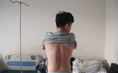 为什么银屑病长期不可以
