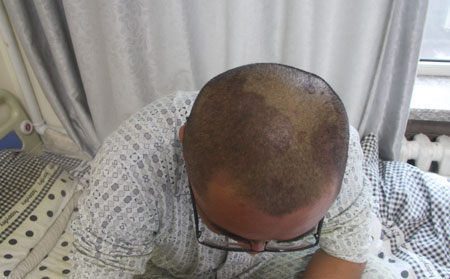 头部银屑病患者在日常生活中应注意哪些问题?