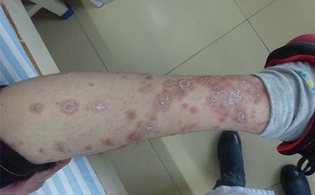 小满时节银屑病养生要点