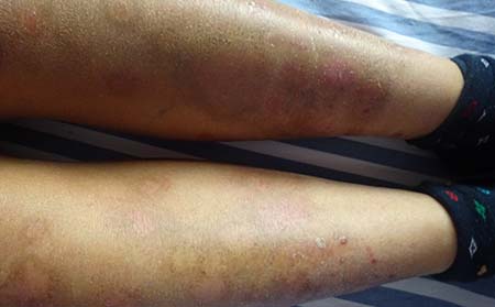 银屑病患者容易犯的立夏养生误区