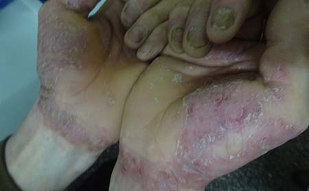 山东银屑病医院幼儿重症银屑病如何治疗好