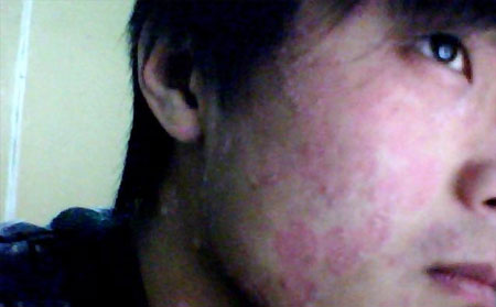 脸上长了牛皮癣要怎么办啊-济南银屑病医院