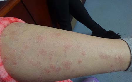 秋季牛皮癣要防感染发生-济南银屑病医院