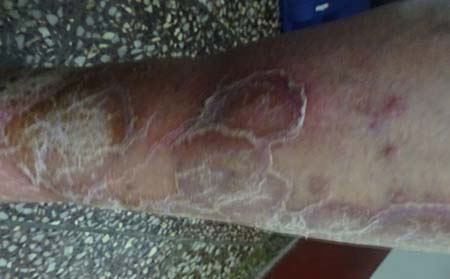 牛皮癣秋季如何防复发-潍坊银屑病医院