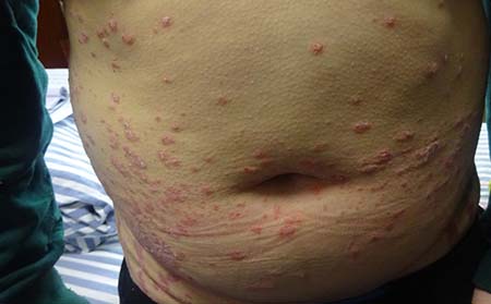 银屑病能吃鱼吗