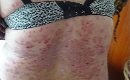 银屑病患者在日常饮食中要注意什么
