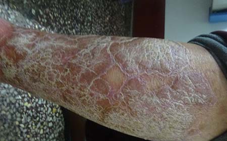 银屑病患者如何做好饮食护理