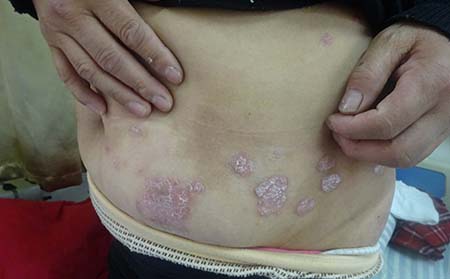 牛皮癣患者需要多睡觉