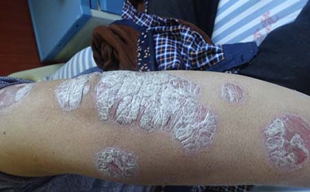 得了银屑病咋办