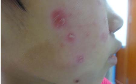 如何护理脸部银屑病