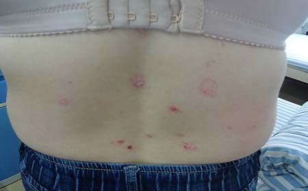 银屑病患者如何缓解夏季烦躁?