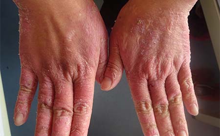 如何护理关节病型银屑病