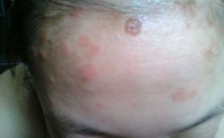 常见的银屑病“食疗”方法有哪些?