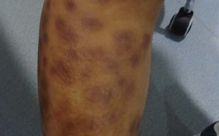 如何护理脓疱型牛皮癣