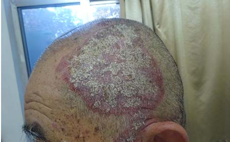 如何护理寻常型银屑病?