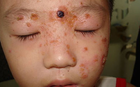 牛皮癣患儿家长该怎样合理护理呢?