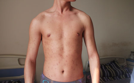 银屑病患者夏季如何防蚊呢？