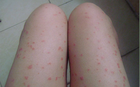 女性得了关节型牛皮癣怎么办可以