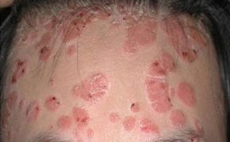 脓疱型银屑病患者不宜吃的水果有哪些呢?