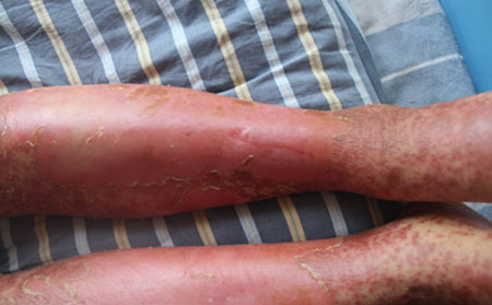 脓疱型银屑病夏季保健要注意什么哪些方面