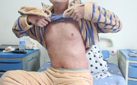 性格诱发银屑病的成因