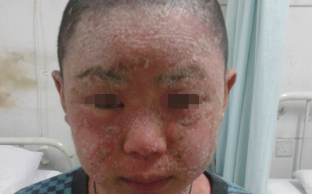 银屑病患者的干燥皮肤有何缘由