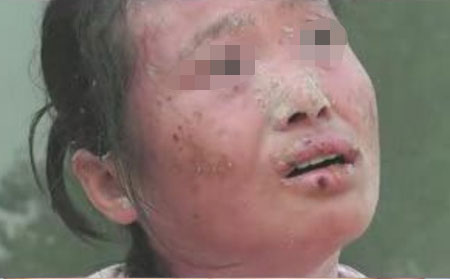 银屑病和怀孕有什么直接关系呢？