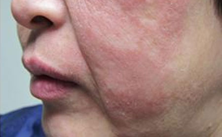 银屑病早期症状