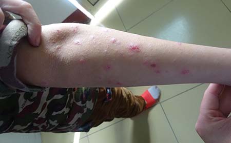 男性银屑病患者注意