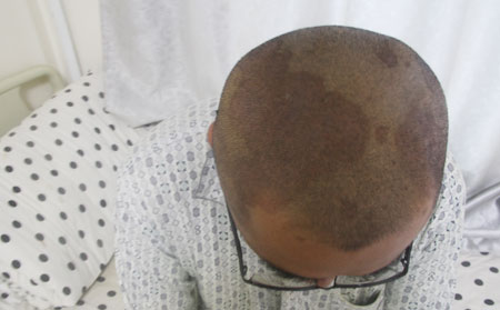 儿童银屑病能治好吗