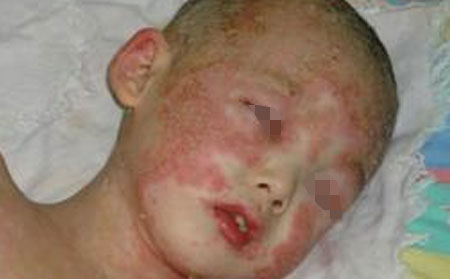 儿童银屑病患者如何避免病情恶化