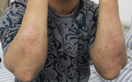 男性银屑病患者如何诊断自己的病情