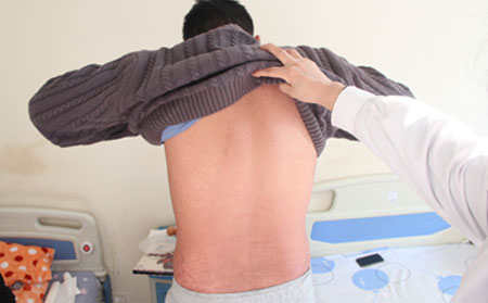 男性银屑病患者夏季如何科学护理