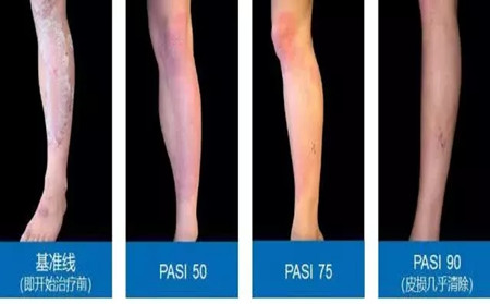 银屑病迎来重磅新药