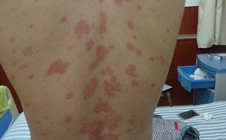 儿童银屑病症状,儿童银屑病典型症状
