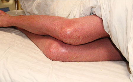 红皮型银屑图片,初期红皮型银屑病症状