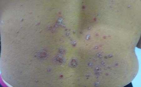 寻常型银屑病症状,寻常型银屑病形态