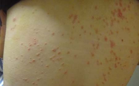 银屑病症状表现,有银屑病症状表现