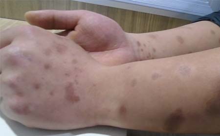 银屑病护理,银屑病皮肤护理