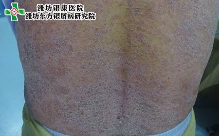 怎样治银屑病,应该怎样治银屑病