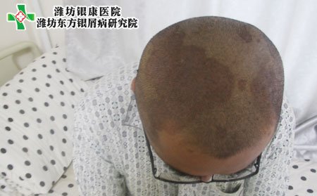 脓疱型银屑病症状,头部脓疱型银屑病症状