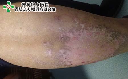 老年银屑病怎么办,老人为什么得银屑病