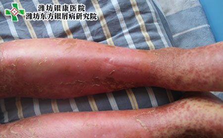 红皮型银屑病症状,红皮型银屑病图片