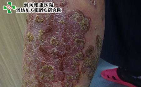 重症银屑病护理,怎样护理重症银屑病