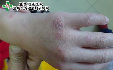 手部银屑病症状,手部银屑病症状特点