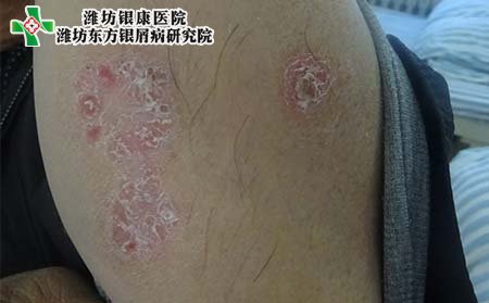 牛皮癣病因,牛皮癣引发的原因