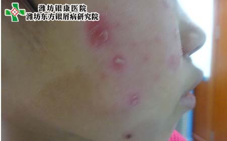 脸部有银屑病,面部长银屑病怎么办