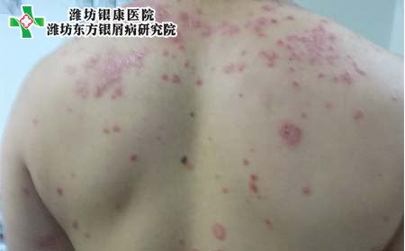 牛皮癣病因,背部牛皮癣病因