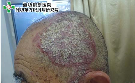 银屑病护理,头部银屑病洗头